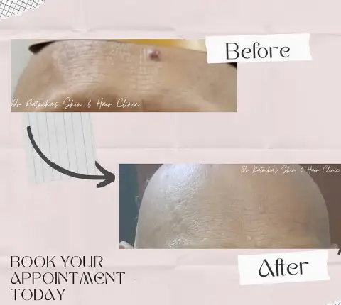 Introducing Cellfina – The Game Changer  in Cellulite Treatment