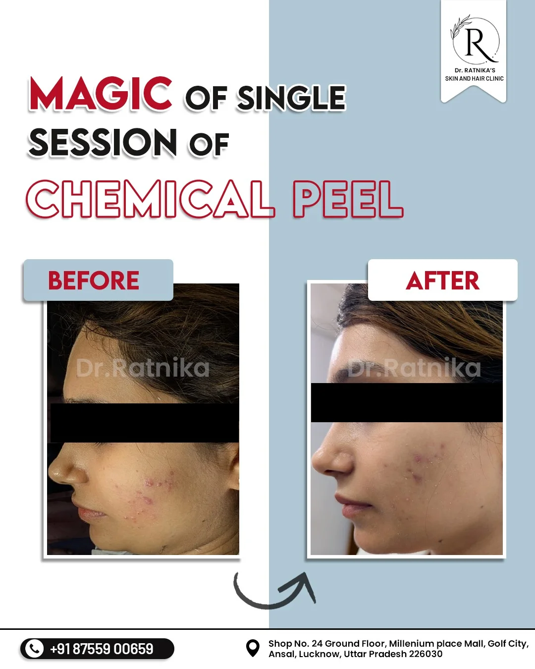 The Basic Rules of Skin Care & Acne Treatment