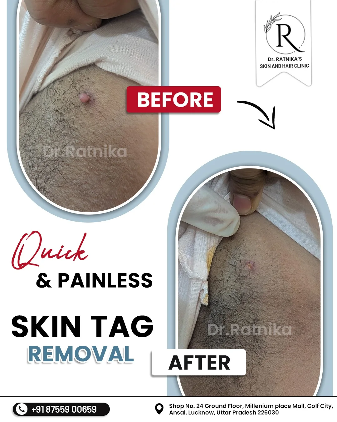 Introducing Cellfina – The Game Changer  in Cellulite Treatment