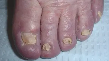  Nail Related Issue