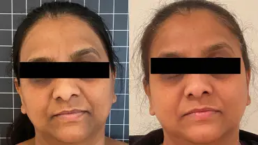 Best Hair Treatment In Lucknow