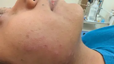 Skin Related Issue