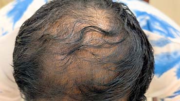 Best Hair Treatment In Lucknow