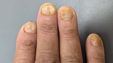  Nail Related Issue