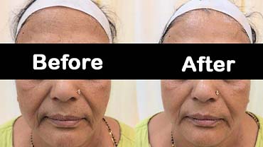 Best Hair Treatment In Lucknow